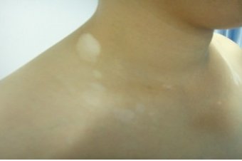 治疗白癜风需要做好哪些事项